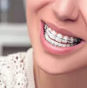 Braces Removal